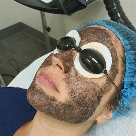 Hollywood Facial In Easton Pa Radiant Skin With Laser Treatment