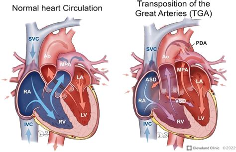 D Transposition Of The Great Arteries The Rastelli Procedure And Its Complications Management