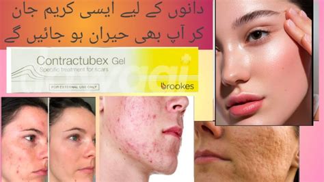 Muh Par Dane Khatam Karne Ka Tarika Pimple Treatment Cream Youtube