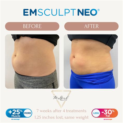 Emsculpt Milford Med Spa