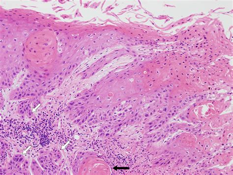 Invasive Squamous Cell Carcinoma Causing Laryngeal Leukoplakia Iowa