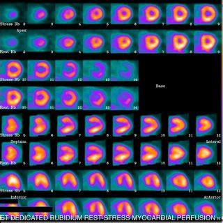 Case Example Cav Myocardial Perfusion Image Of An Years Old Heart