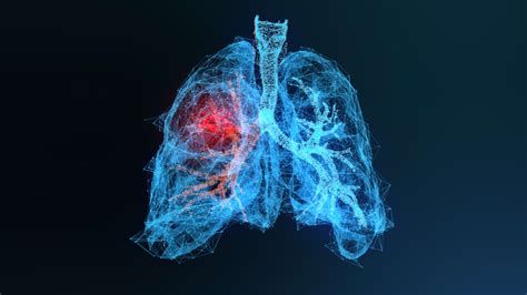 Bronchoscopic Lung Volume Reduction In Patients With Advanced Emphysema