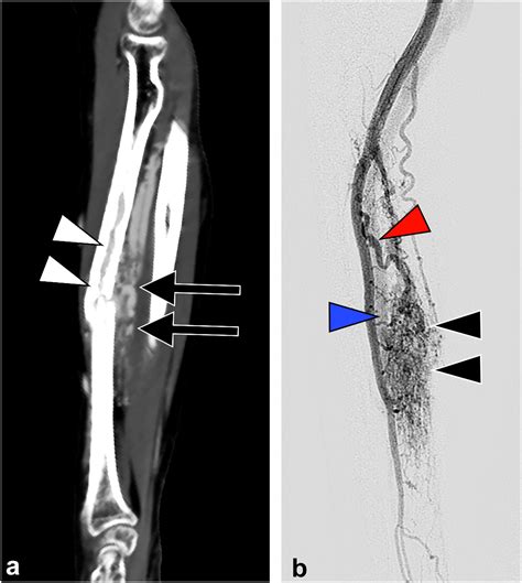 Treatment of a Pathologic Radial Fracture Associated with an