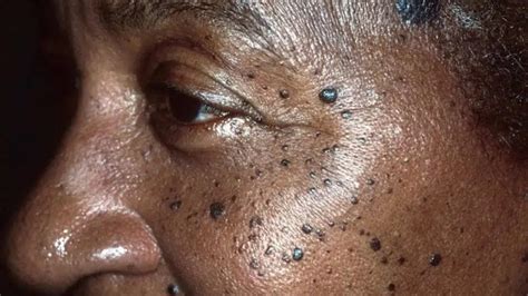 Seborrheic keratosis: Causes, symptoms, diagnosis and treatment of wart ...