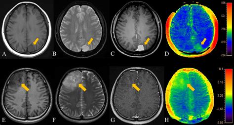 Frontiers Differentiation Of Meningiomas And Gliomas By Amide Proton