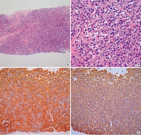 Figure 2 From Solitary Extramedullary Plasmacytoma Of The Liver Without