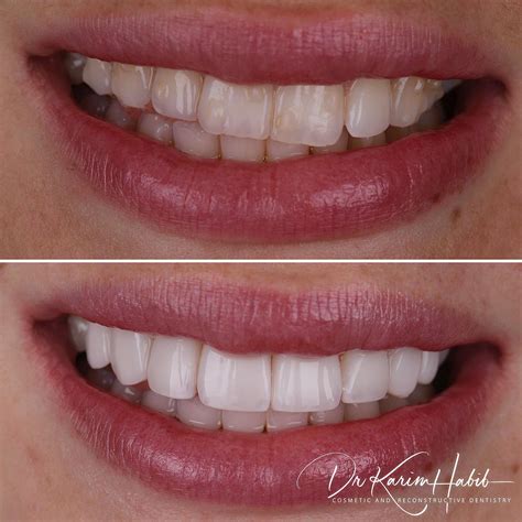 Composite Veneers Sydney Dental Bonding Sydney Dentist Ryde