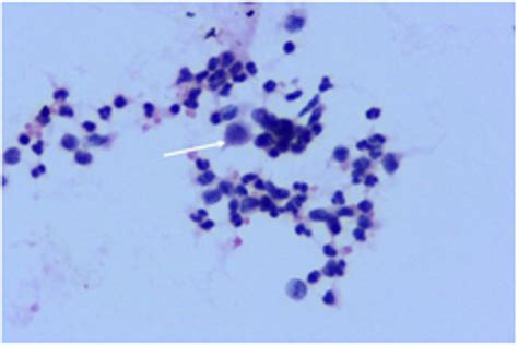 Figure 2 From Role Of Fine Needle Aspiration Cytology Fnac As A