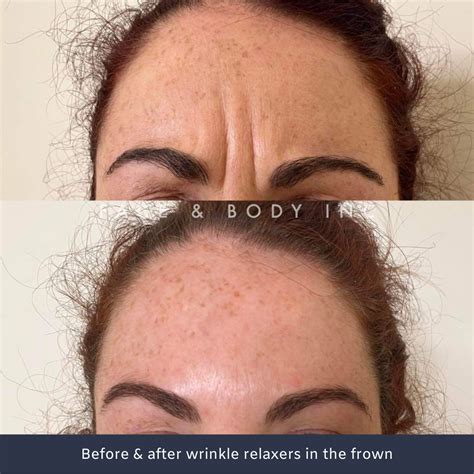 Wrinkle Relaxers Perth Anti Wrinkle Injections Face And Body Inc