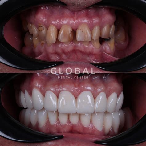 Zirconia Crown Global Dental Center Turkey Dental Clinic In Antalya Turkey