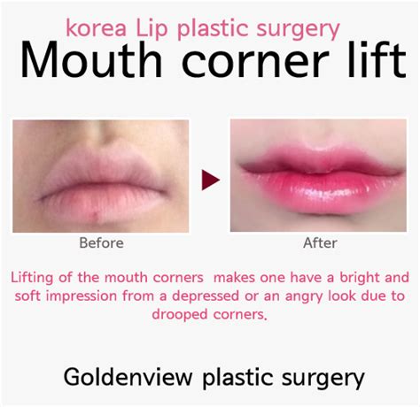 Goldenview Plastic Surgery Lips Plastic Surgery Before And After