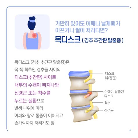 오십견 증상 및 어깨통증 치료 방법유착성관절낭염 운동 스트레칭 겨울애상