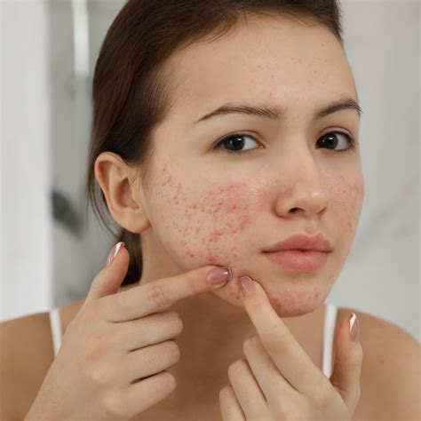 Acne Vulgaris Causes Symptoms And Effective Treatments The Adare Clinic