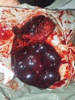 Como É Feito O Aborto Espontâneo - Aborto espontâneo | BabyCenter