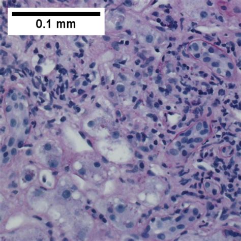 Primary Biliary Cirrhosis Libre Pathology