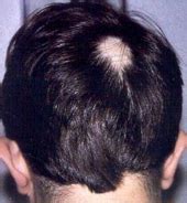 Alopecia Areata Medlibes Online Medical Library