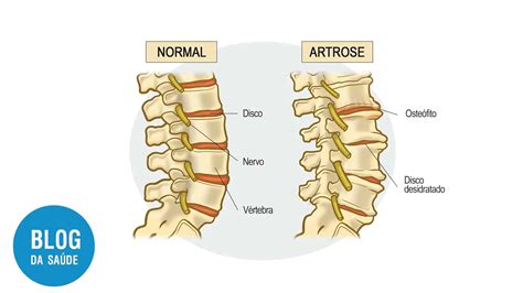 Artrose Interfacetária O Que é E Como Tratar Blog Da Saúde