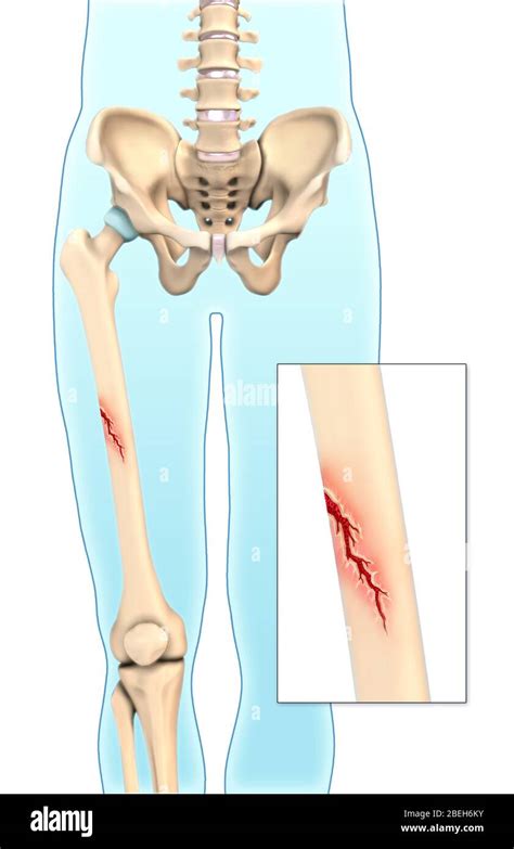 Greenstick Bone Fracture Illustration Stock Photo Alamy