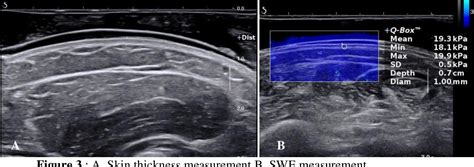 Figure 3 from Role of shear wave elastography ultrasound in patient with scleroderma | Semantic ...