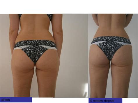 Lipo No Culote Antes E Depois