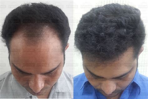 hair replacement men cost 8
