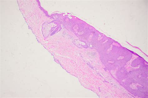 Dermoscopy Atlas | Diagnosis Detail