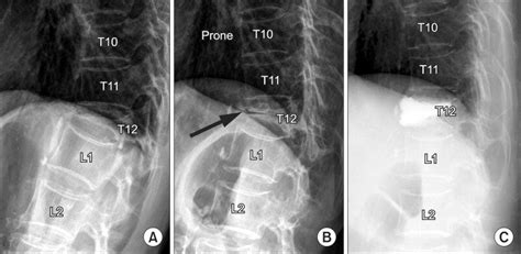 illustration  intravertebral instability   compression