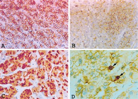 expression  catenin protein  diffuse staining  catenin