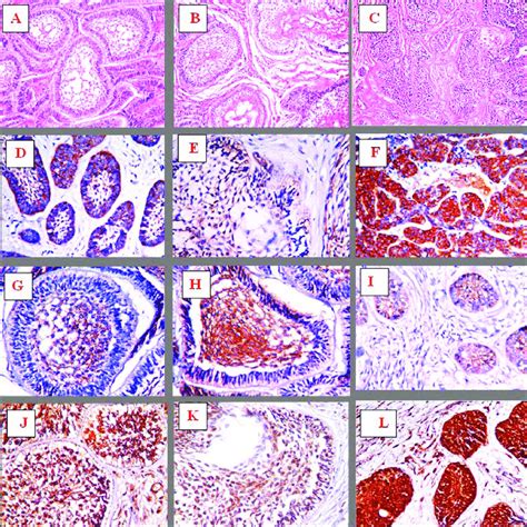 Follicular Ameloblastoma Showed Multiple Islands Of Odontogenic