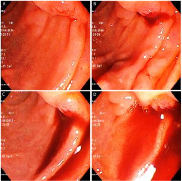 Hemosuccus Pancreaticus From Gastroduodenal Artery Pseudoaneurysm