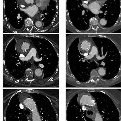 The Ct Scan Revealed A Stanford Type B Aortic Dissection Combined With