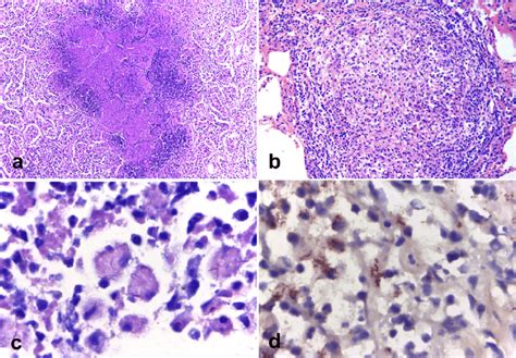 Microscopic features of Mycobacterium tuberculosis var. tuberculosis ...