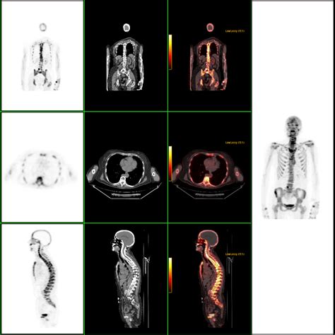 PET/CT SCANNER | River Radiology