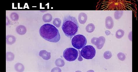 Fichero De Hematologia Leucemia Linfoide Aguda