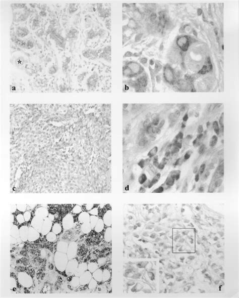 A Lobular Carcinoma In Situ Showing An Intense Reaction To Pcph Download Scientific Diagram