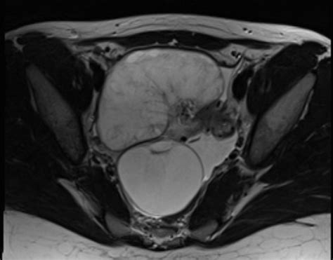 Ovarian Torsion Radiology Reference Article