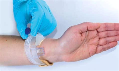 Distal Radial Artery Lowers Risk Of Hematomas Occlusion Jacc
