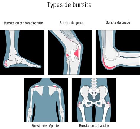 Bursite Hygroma Comment La Faire Dispara Tre