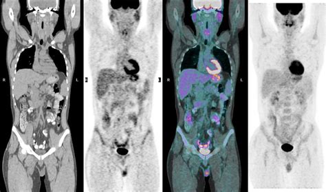 F Fdg Pet Ct Image After Cycles Of Bep Regimen The Pathological