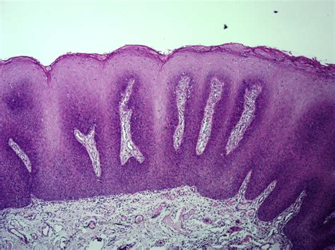 Severe epithelial dysplasia with candidal super infection mimicking ...