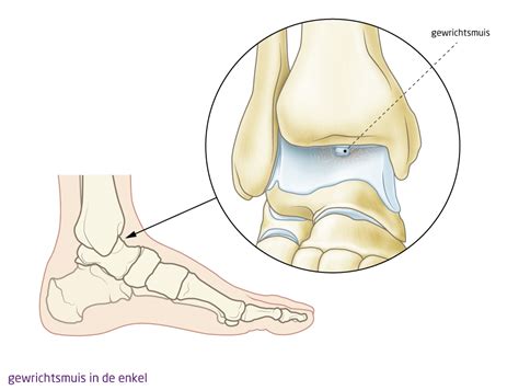 gewrichtsmuis enkel corpus liberum dr afcm sjors moonen voet