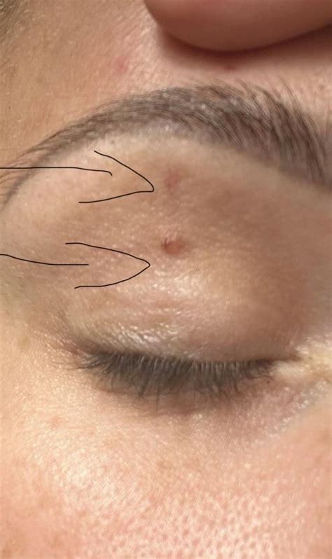 Eyelid Mole Rmelanoma