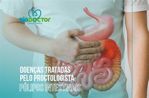 Cuidados Após Retirada De Pólipos Intestinais - Doenças tratadas pelo Proctologista: Pólipos intestinais – Clínica Big ...