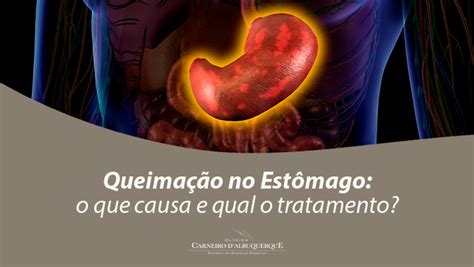 O Que Causa Queimação - Queimação No Estômago: O Que Causa E Qual O Tratamento? - Prof Dr. Luiz ...