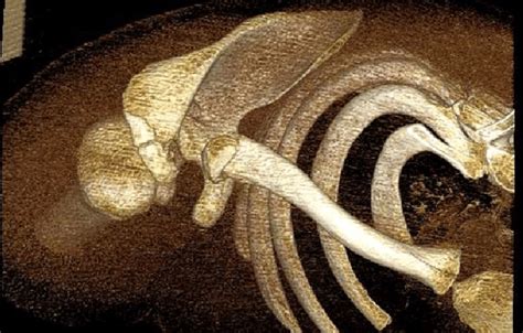 Computed tomography scan. Three-dimensional reconstruction showing ...