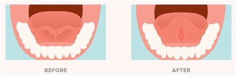 Mucocele And Tongue Tie Frenectomy Dr Changule S Face Clinic And