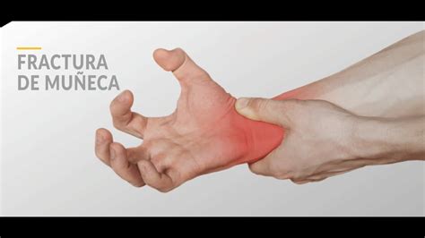 Fractura De Muñeca Indicaciones Youtube