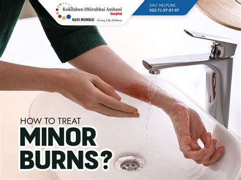 How To Treat Minor Burns
