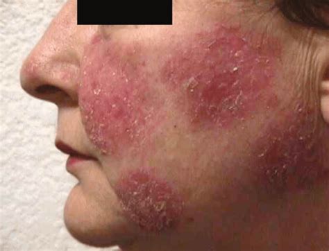 pemphigus vulgaris treatment dr thinds homeopathy